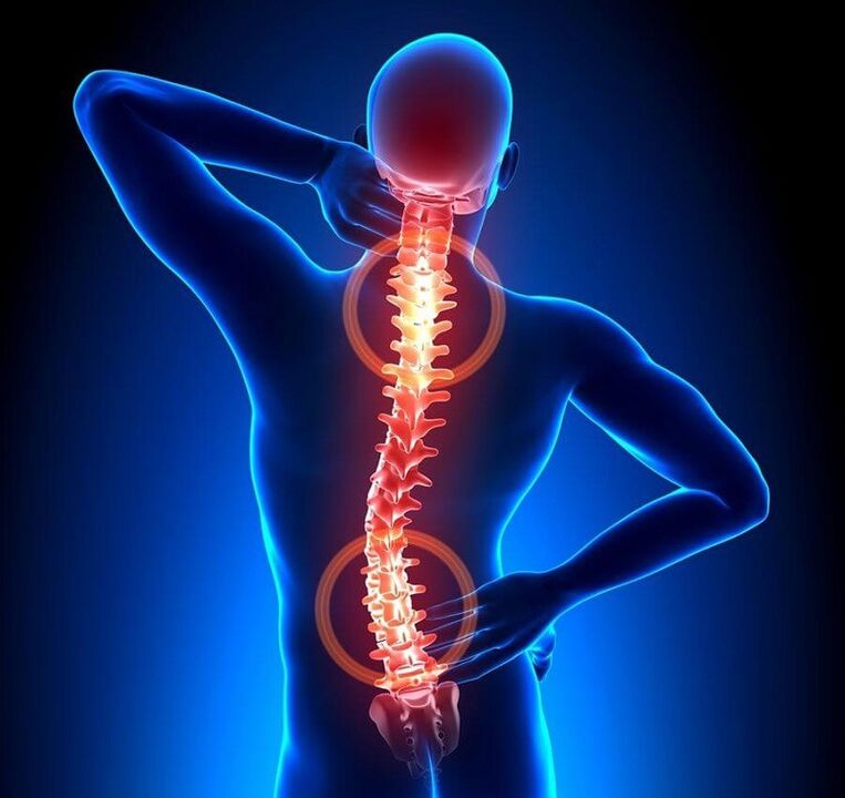 osteochondroza kręgosłupa jako przyczyna bólu pleców