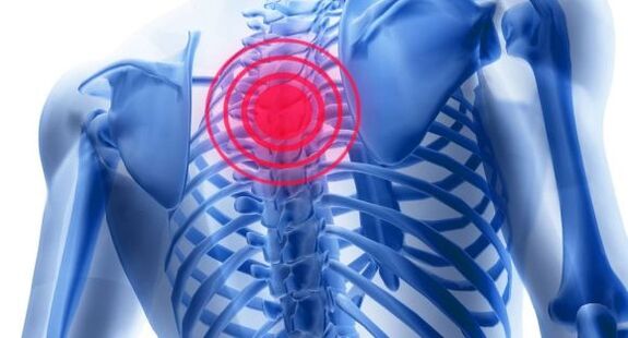 Leczenie osteochondrozy kręgosłupa klatki piersiowej