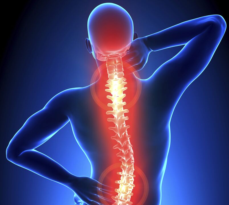 Osteochondroza kręgosłupa