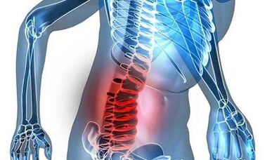 Objawy osteochondrozy lędźwiowej