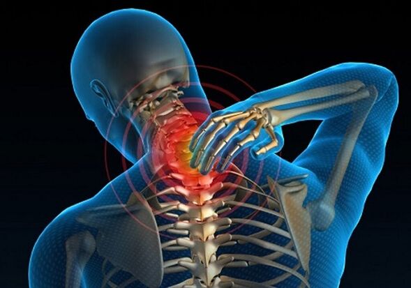 ból szyi z powodu osteochondrozy